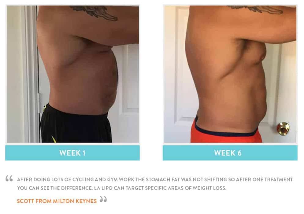 Before & After Stomach Fat Bury St Edmunds