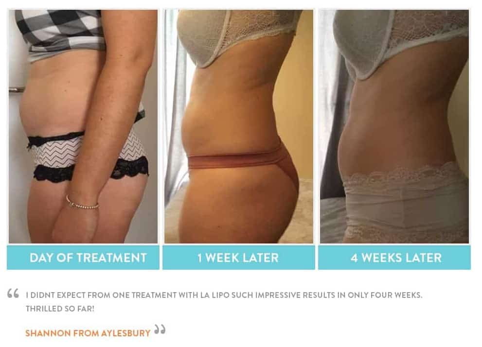 before, Cryolipolysis Bury St Edmunds