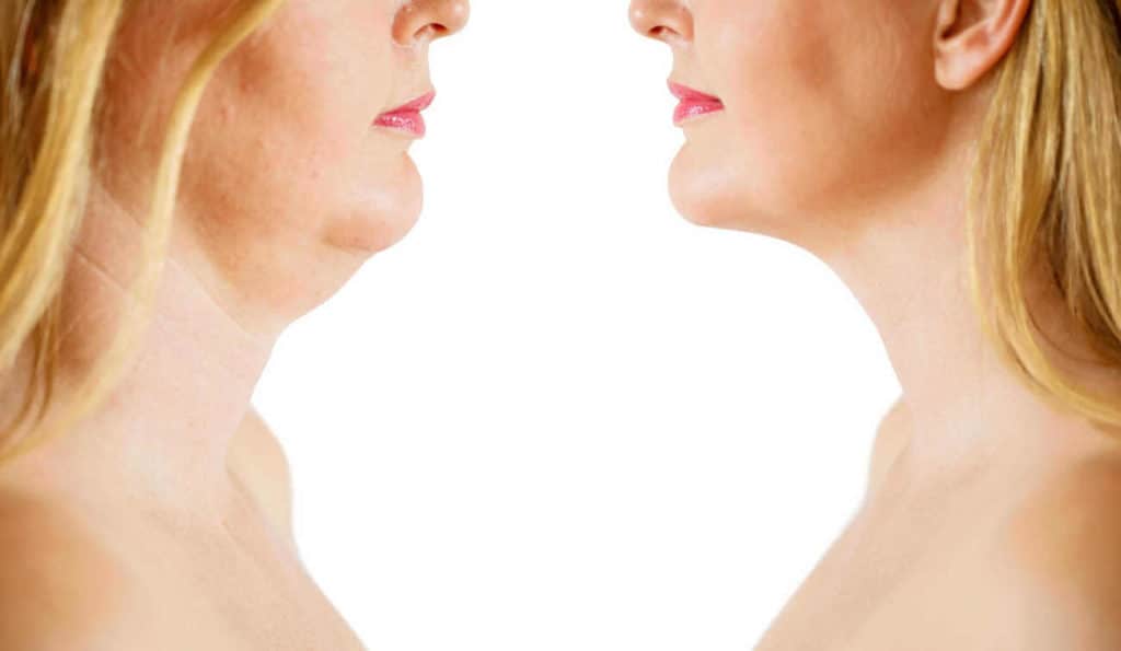 Double Chin treatment Bury St Edmunds before and after results