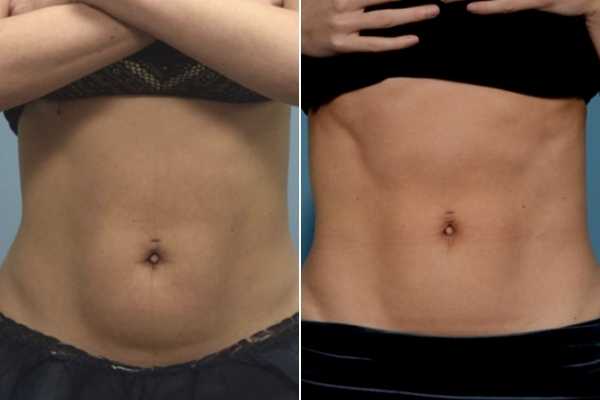 body sculpting FAQs Bury St Edmunds