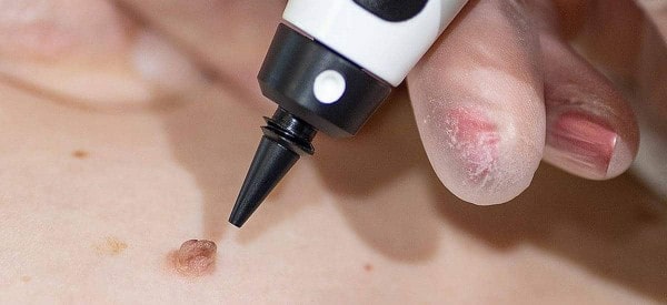 After Skin Tag Removal Bury St Edmunds
