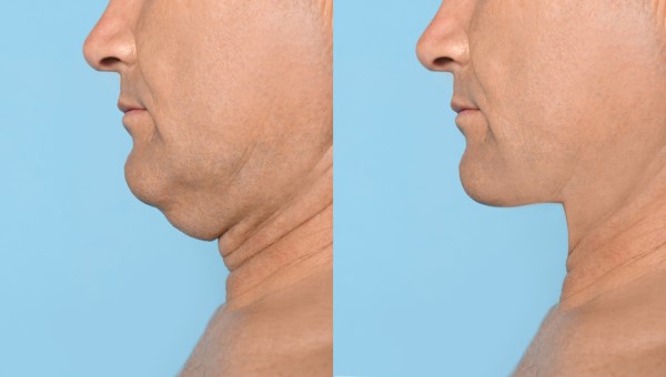 Which Non-Surgical Treatments Work Best for Jowls and Loose Skin Bury St Edmunds?