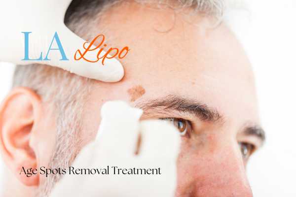 What Are the Most Effective Treatments for Age Spots Bury St Edmunds?