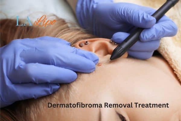 Dermatofibroma Removal Treatment Bury St Edmunds