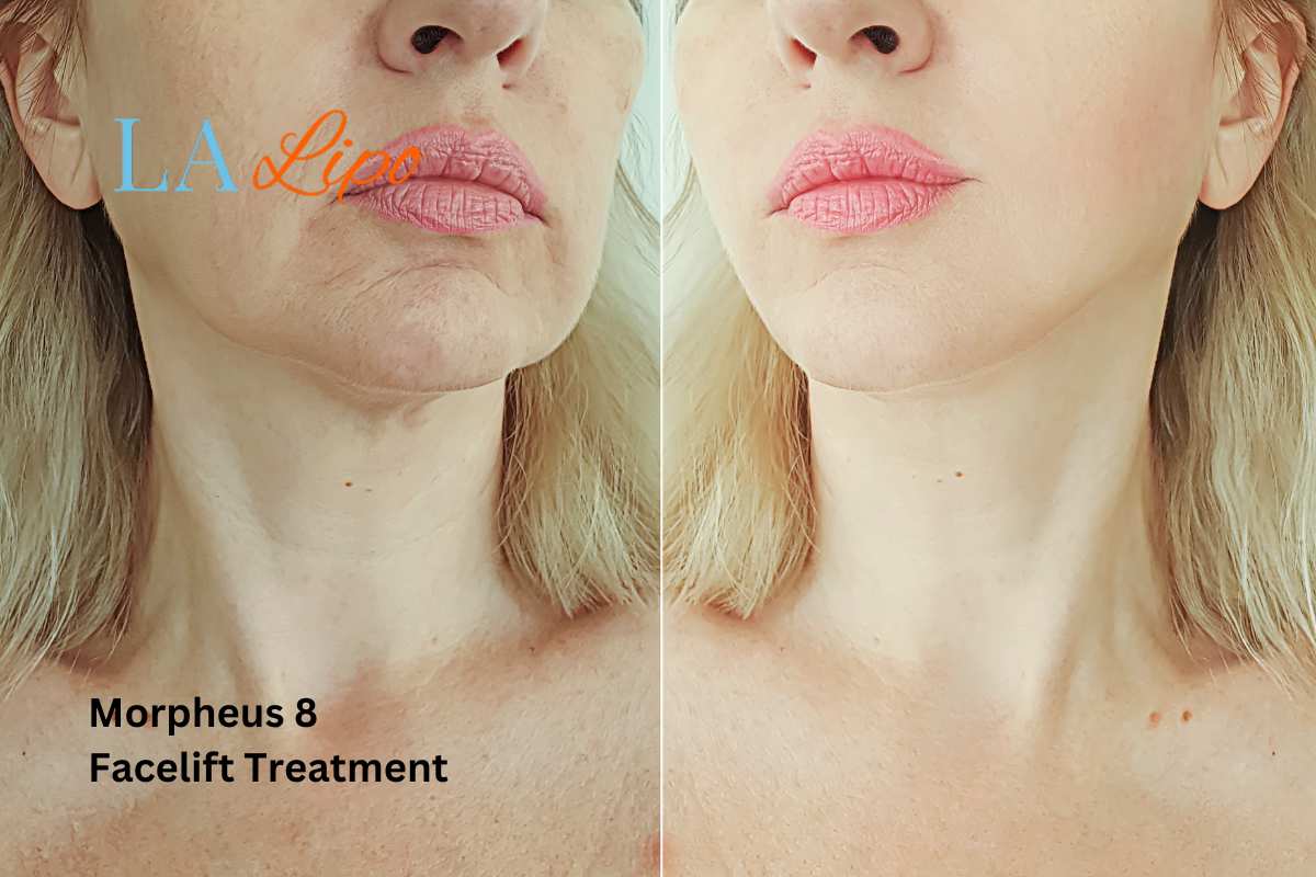 Turn back time with Morpheus8 Treatment Bury St Edmunds