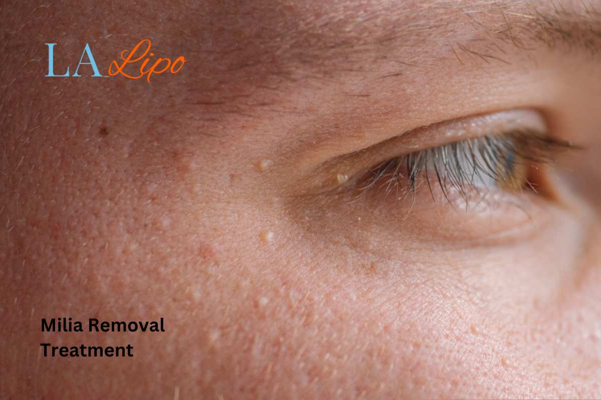 Cryopen Milia Removal: Is It the Easiest and Safest Option Bury St Edmunds?
