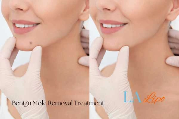 Before and after mole removal Bury St Edmunds treatment