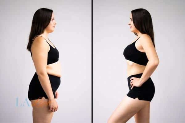 image of woman before and after results of LA-EMS Body Sculpting Bury St Edmunds to help treat Diastasis recti
