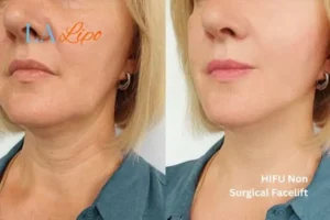 hi-fu for wrinkles Bury St Edmunds before and after results