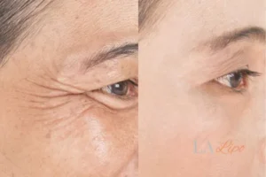 Before and after results of woman - HI-fu wrinkles reduction treatment Bury St Edmunds