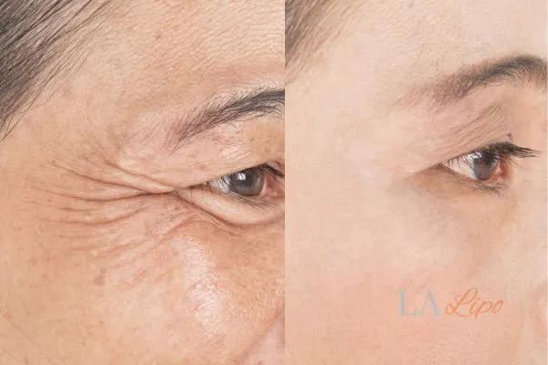 Before and after results of woman - HI-fu wrinkles reduction treatment Bury St Edmunds