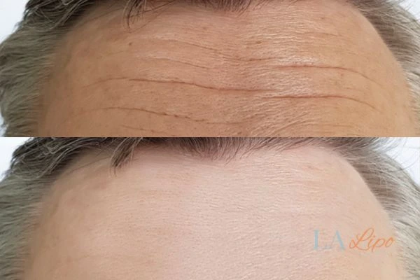 results of HIFU Bury St Edmunds on mans forehead to help reduce lines and wrinkles