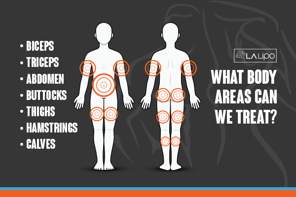 Graphic to show areas you can have LA-EMS Body Sculpting Bury St Edmunds treatment.