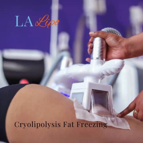fat freezing - Cryolipolysis Bury St Edmunds