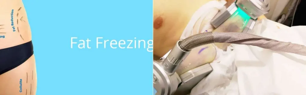 Fat freezing Bury St Edmunds on multiple areas of the body