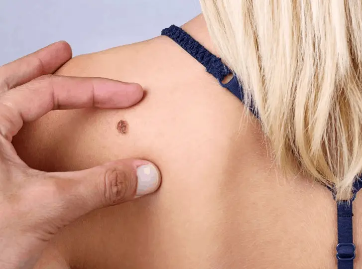 woman having mole removal Bury St Edmunds consultation before treatment.