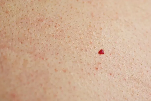 close up of a cherry angioma Bury St Edmunds