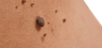 image of a skin tag Bury St Edmunds