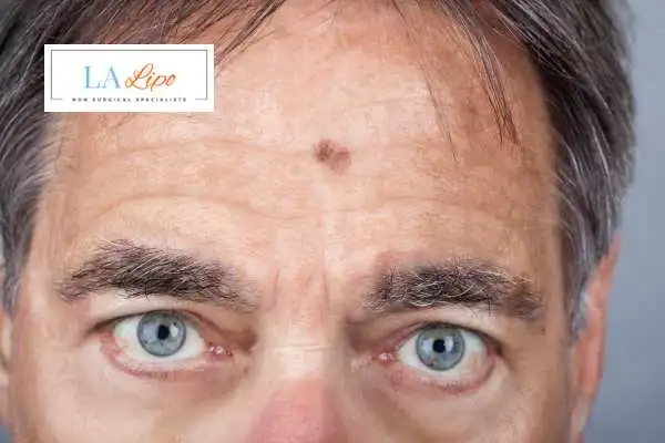 Solar Lentigo Removal Bury St Edmunds image of man with mark on his forehead