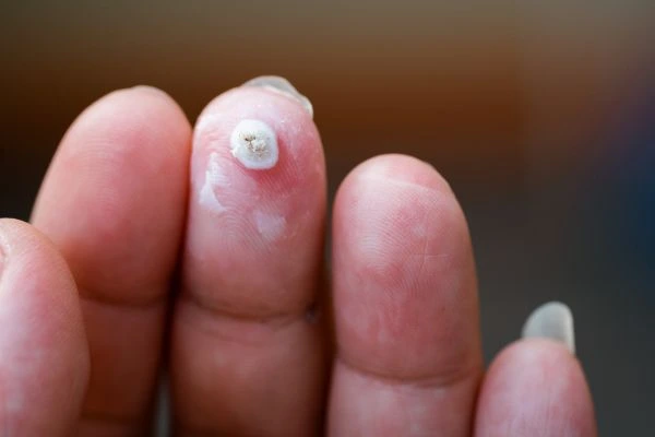 wart on person finger - cryotherapy to treat from LA LIPO Bury St Edmunds