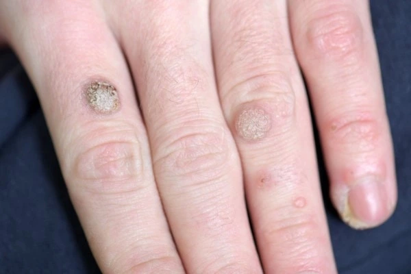 photo of warts on person hand - see wart removal Bury St Edmunds from LA LIPO