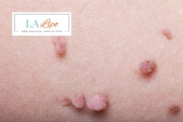 Does cryopen skin tag removal Bury St Edmunds hurt? Find out now call our team today!