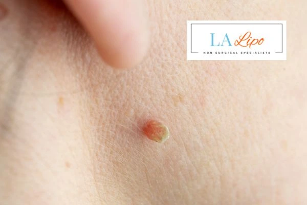 Book skin tag removal Bury St Edmunds today speak to our team now!