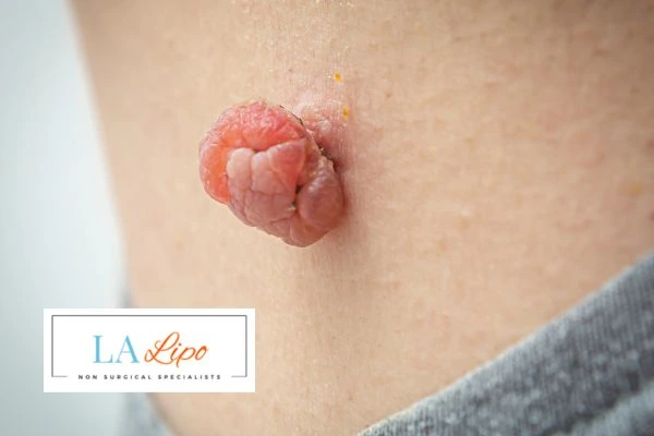 Interested in skin tag removal Bury St Edmunds? Concerned about the pain? Find out more today!