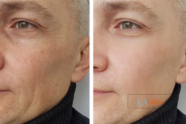See the amazing results of Morpheus8 Treatment Bury St Edmunds!