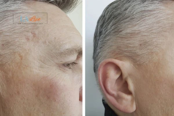 Mens Before & After Morpheus 8 Results Bury St Edmunds