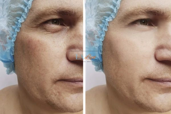 Before and after Morpheus 8 Results Bury St Edmunds