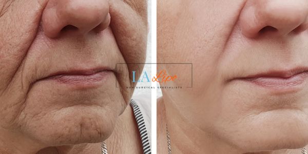 Older lady deeper wrinkle reduction - LA LIPO Morpheus 8 Results Bury St Edmunds
