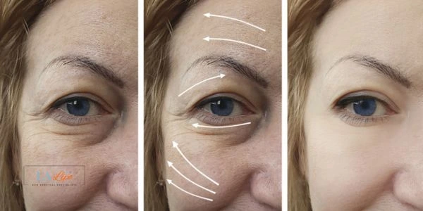 Amazing eye lift Morpheus 8 results Bury St Edmunds