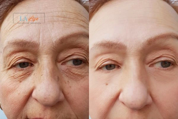 The powerful benefits of Morpheus8 Treatment Bury St Edmunds - Call Our team today!
