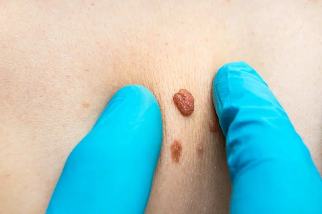 LA LIPO Cryopen Lesion Removal Prices Bury St Edmunds