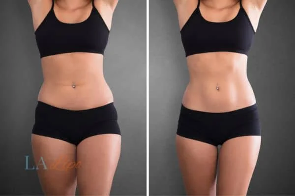 before and after results of non-surgical treatment to help a woman's body image and mental health Bury St Edmunds