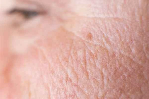 close up picture of a woman's face showing an age spot Bury St Edmunds