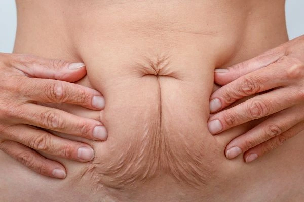 Image of a woman's stomach with loose skin - example of skin tightening Bury St Edmunds options